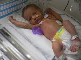 Blog Bookongan Pics Of Babies Born At 32 Weeks