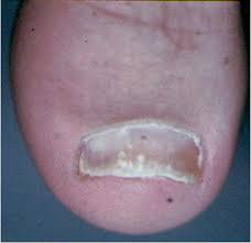 Image result for Pitting nails feet