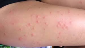 Biting midges can be a nuisance to campers, fishermen, hunters, hikers, gardeners, and others who spend time outdoors during early morning and evenings the pedicel of the males' antennae houses the johnston's organ. Fly Bites Symptoms And Treatments