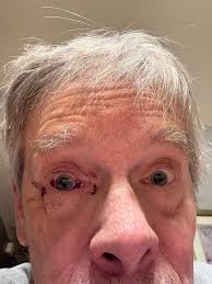 Do people experience excruciating pain after eye injections?