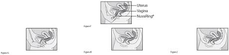 And once inserted, it doesn't have to be in any specific position to work. Etonogestrel And Ethinyl Estradiol Vaginal Ring Wikidoc