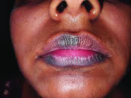 Image result for Fixed Drug Eruption