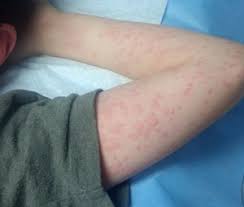 Anaphylaxis is when you get severe allergic reactions. How To Assess And Treat Anaphylaxis