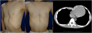 The abnormal growth causes the sternal bone to move inward and sometimes causes the sternum to rotate to one side or the other. Nuss Procedure For Patients With Pectus Excavatum With A History Of Intrathoracic Surgery Journal Of Plastic Reconstructive Aesthetic Surgery
