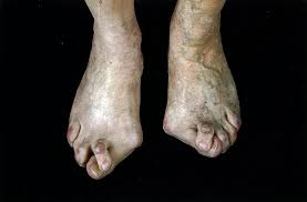 Foot definition, (in vertebrates) the terminal part of the leg, below the ankle joint, on which the a unit of length, originally derived from the length of the human foot. Foot Deformities Amboss