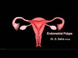 A systematic review of 17 observational studies including over 10. Video 6 1 Endometrial Polyps Youtube