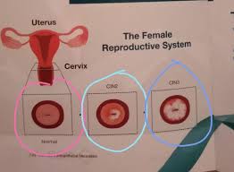 Sakit mawadah menunjukkan papaniculaou kelas i. Aku Terima Ujianmu Tahu Berisiko Tinggi Hidap Kanser Serviks Selepas Ujian Pap Smear