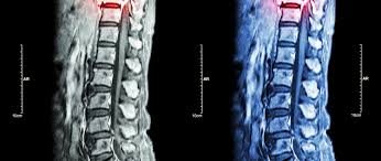 Check spelling or type a new query. Consequences Of Leaving A Herniated Disc Untreated