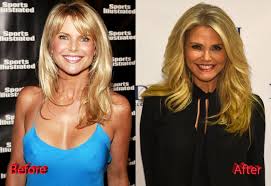 Plastic surgery procedures started as medical treatments but grew into cosmetic surgeries. Christie Brinkley Plastic Surgery What Do You Think