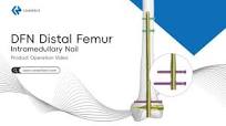 DFN Distal Femoral Nail | Intramedullary Fixation for Distal Femur Fractures