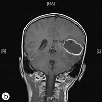 Can an infected tooth cause a fever. Brain Abscess Secondary To A Dental Infection In An 11 Year Old Child Case Report Jcda