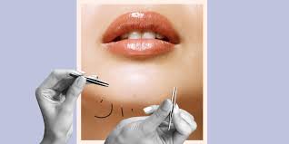 Overproduction causes androgen levels to increase. Female Chin Hair 6 Things Hair On Your Chin Can Mean