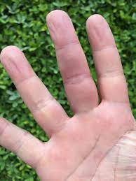 Compromiso Del Dedo Medio De La Mano Derecha Download Scientific Diagram