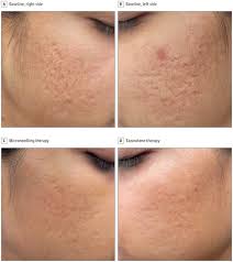 Adapalene was created for superior tolerability compared to other prescription retinoid products not containing adapalene; Topical Tazarotene Gel 0 1 As A Novel Treatment Approach For Atrophic Postacne Scars A Randomized Active Controlled Clinical Trial Jama Facial Plastic Surgery Vol 21 No 2
