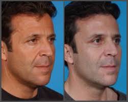 midface-lift-with-blepharoplasty-1b
