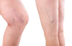 5 Varicose Veins Natural Treatment Options
