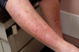 Hal ini penting agar kulit anda tidak sampai lecet atau infeksi karena terlalu sering digaruk. Kulit Terbakar Dan Melepuh Ini Gejala Dermatitis Herpetiformis
