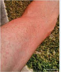 Babies often develop heat rash on their necks, but it can also. Papular Skin Rash On Arm A Common Symptom Of Zika Fever Download Scientific Diagram
