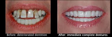 Extraction of remaining maxillary teeth followed by immediate denture placement! Immediate Dentures North Shore Dental Browns Bay Auckland