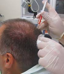 The platelets, one type of blood cells, contain growth factors that can trigger cell proliferation, speed healing and stimulate tissue regeneration in the treated area. Will Prp Work For My Hair Loss