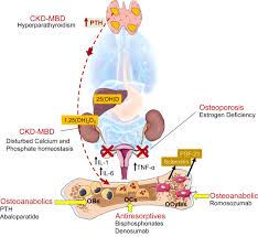 Osteoporosis And Chronic Kidney Disease Mineral And Bone Disorder Ckd Mbd Back To Basics American Journal Of Kidney Diseases