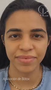 Colocación de toxina Botulínica (Botox)., Corrigiendo las Líneas de  Expresión, entre Cejas y Patas de Gallina., La paciente feliz con los  resultados!, 𝗗𝗿. 𝗖é𝘀𝗮𝗿 𝗟𝗼𝗿𝗮., 𝗘𝘀𝗽𝗲𝗰𝗶𝗮𝗹𝗶𝘀𝘁𝗮 𝗲𝗻  𝗔𝗿𝗺𝗼𝗻𝗶𝘇𝗮𝗰𝗶ó𝗻 ...