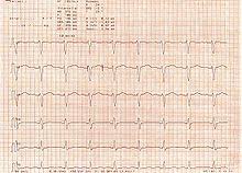 Myocarditis (mk) is a cardiovascular disease characterized by heart muscle damage due to the development of inflammation in the tissues of the organ. Qt Syndrom Wikipedia