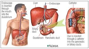 The condition remained undiagnosed for a while. Gallstones Symptoms Causes Treatment Guts Uk