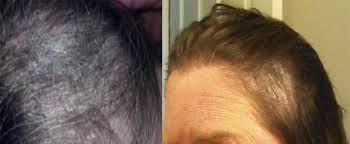 They claim that the wen products can cause severe and possibly permanent damage to hair, including significant hair loss to the point of visible bald spots, hair breakage, scalp irritation, and. Wen Hair Care Lawsuit See Photos Of Hair Loss People Com