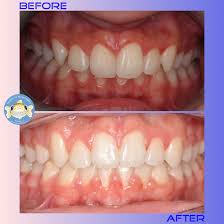 Our August Before And After Results Smile Beforeandafter Realresults Glendale Orthodontist Orthodontics Invisible Braces Orthodontics Straight Teeth
