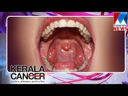 While throat cancer symptoms can vary depending on where exactly the tumor develops, pain or difficulty swallowing is known to be a common symptom across the board. Dr V C Raveendren Speaks About Oral Cancer And Treatments Manorama News Youtube