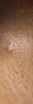 The gentle massage and heat from the water may draw the hair out. Ingrown Hairs On Vag