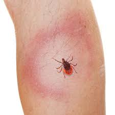 Doch was ist wenn man den zeckenbiss nicht bemerkt? Borreliose Symptome Behandlung Spatfolgen Praktischarzt