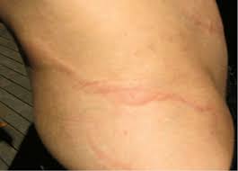 Image result for Strongyloides