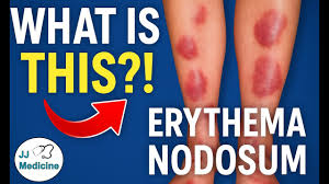 Image result for erythema nodosum