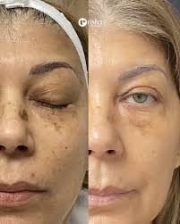 Ashley BSN, RN, PHN Nurse Injector at Rella Aesthetic's Medspa