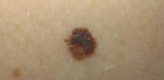 Skin cancer is the most common type of cancer in the united states by a pretty large margin, and it does not discriminate. The Stages Of Melanoma Development Critical Health Information You Need To Know Molemap Australia
