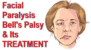 Stroke, and what you should know about recovery. Facial Paralysis Bell S Palsy Treatment Youtube