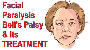 Why is it called bell's palsy? Bell S Palsy Cause Symptom Physiotherapy Treatment