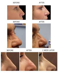 15 Minute Nose Job Is A Safe Non Invasive Alternative To Traditional Rhinoplasty Non Surgical Rhinoplasty Nose Job Avoids The Complications Typically Makiyazh