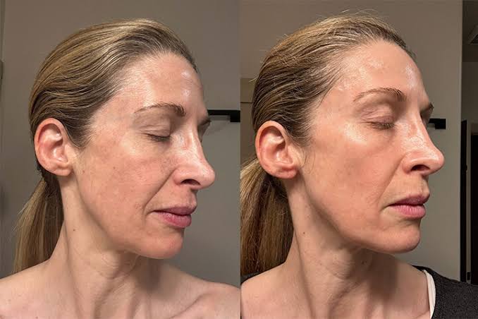 Chemical Peels | Montrose Dermatology + Cosmetics