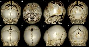 Image result for Craniotabes