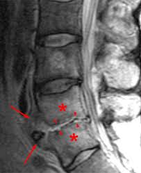 Backbones are typically fiber optic trunk lines. Discitis Radsource