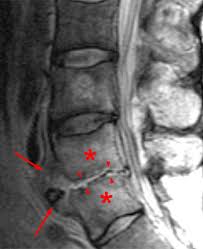 In the united states, only about 3 percent of all tb cases affect the musculoskeletal system. Discitis Radsource