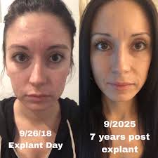 Healing journey after breast implant removal