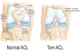 Partial microscopic tearing of the ligament, minimal to no loss of function, mild swelling and pain. Anterior Cruciate Ligament Injury Causes Treatment