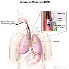 Lung cancer develops in the cells of the lungs. Non Small Cell Lung Cancer Hematology Oncology Associates Of Cny