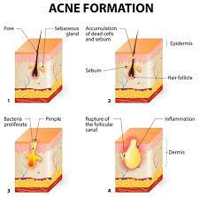 Natural Treatments For Acne That Work