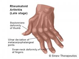 Rheumatoid Arthritis Information Sinew Therapeutics