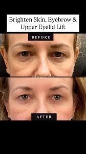 **Tone? ✔️. Texture? ✔️. Lift + Tighten? ✔️✔️.** Scarlet SRF and Agnes RF  are the *power couple* of skin rejuvenation., Using advanced radiofrequency  technology, these treatments dive deep beneath the ...